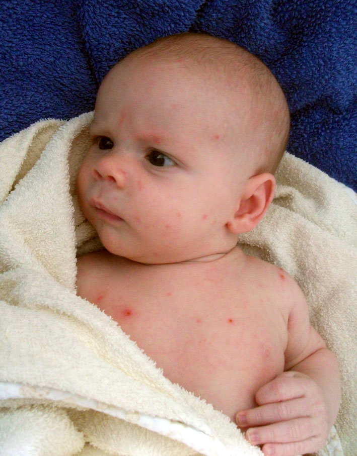 Can A Unborn Baby Catch Chicken Pox